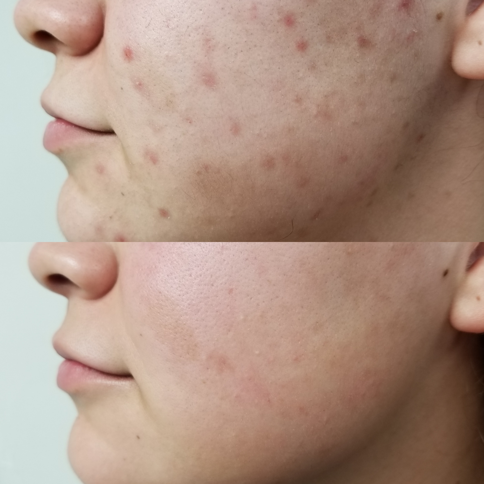 Acne 1 Antes y Despues