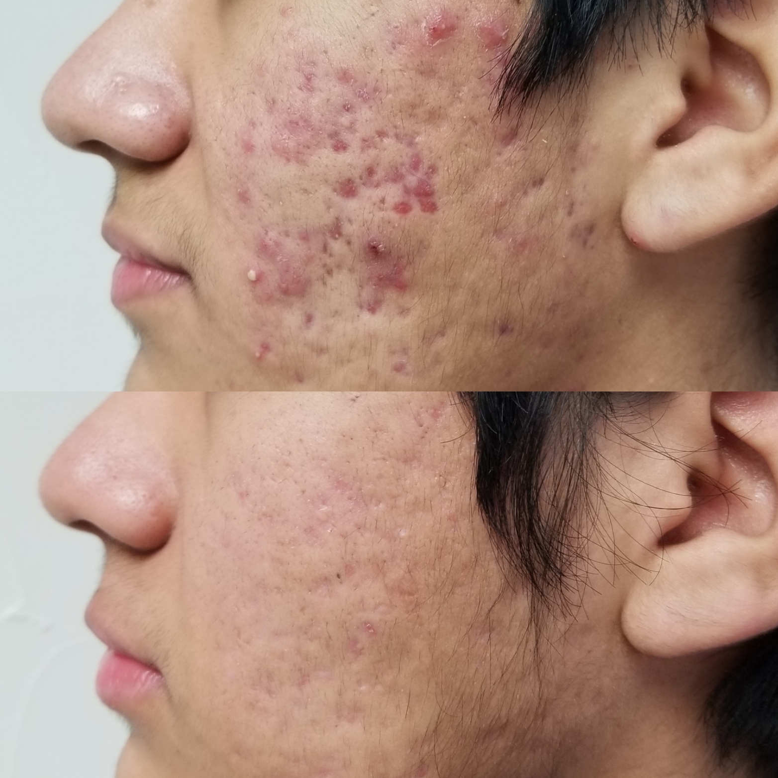 Acne 3 Antes y Despues