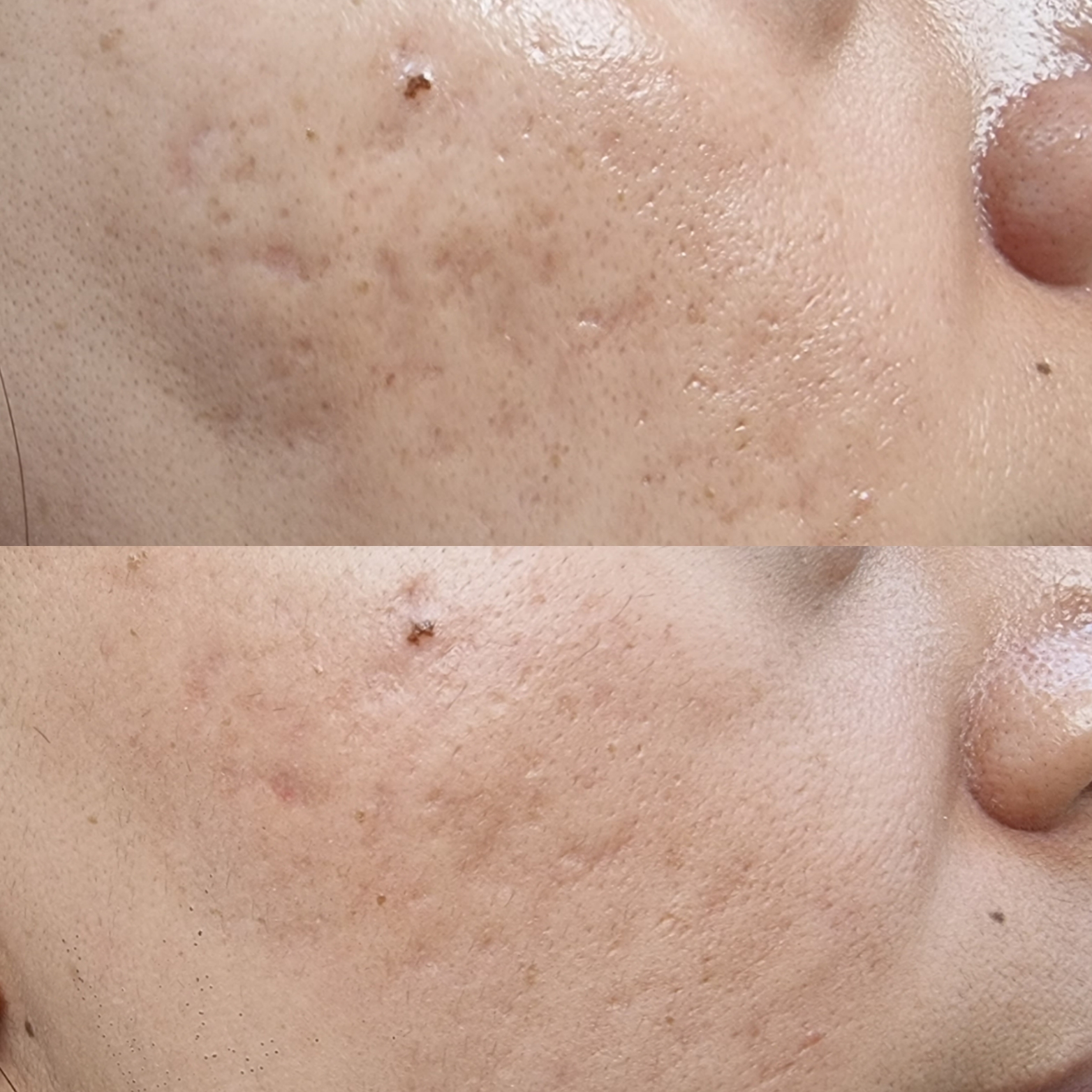 Laser CO2 3 Antes y Despues