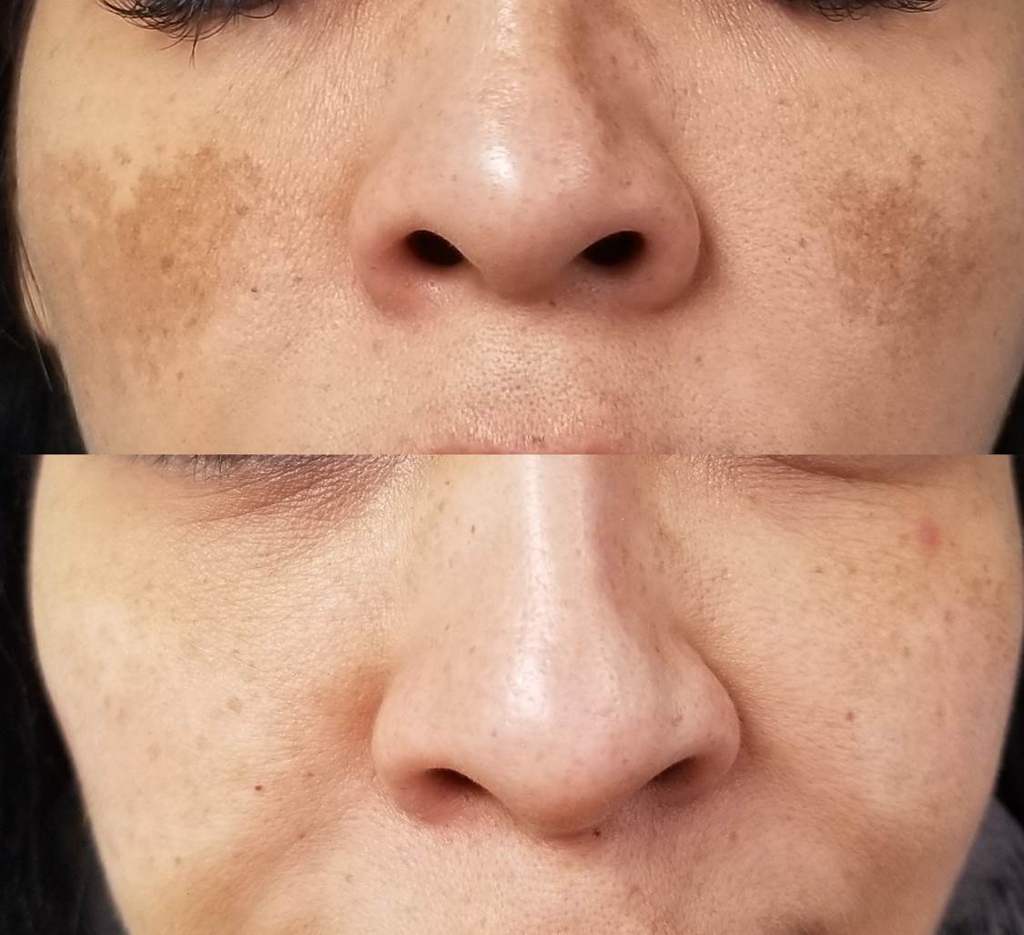 Melasma 1 Antes y Después