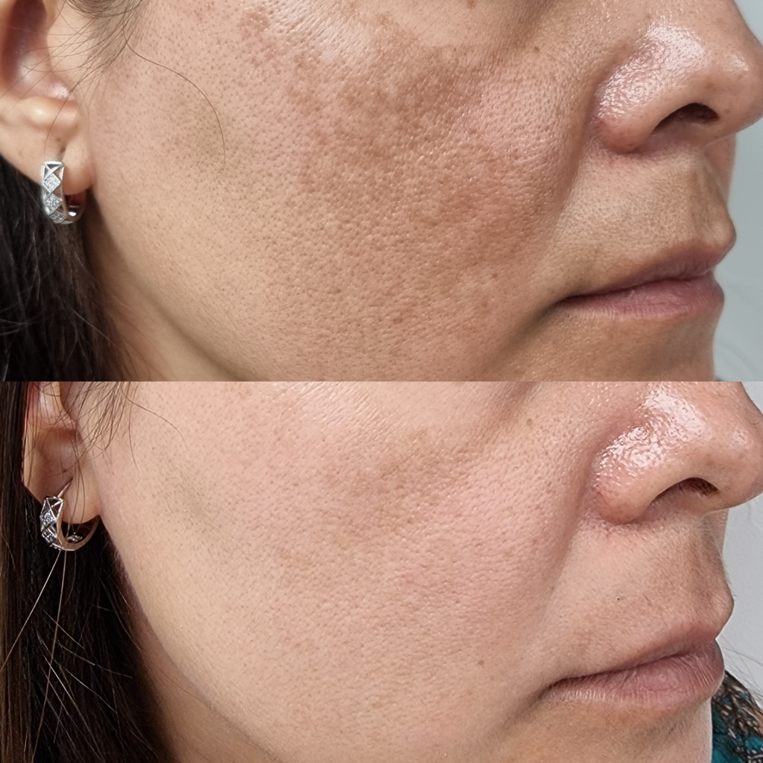 Melasma 2 Antes y Despues