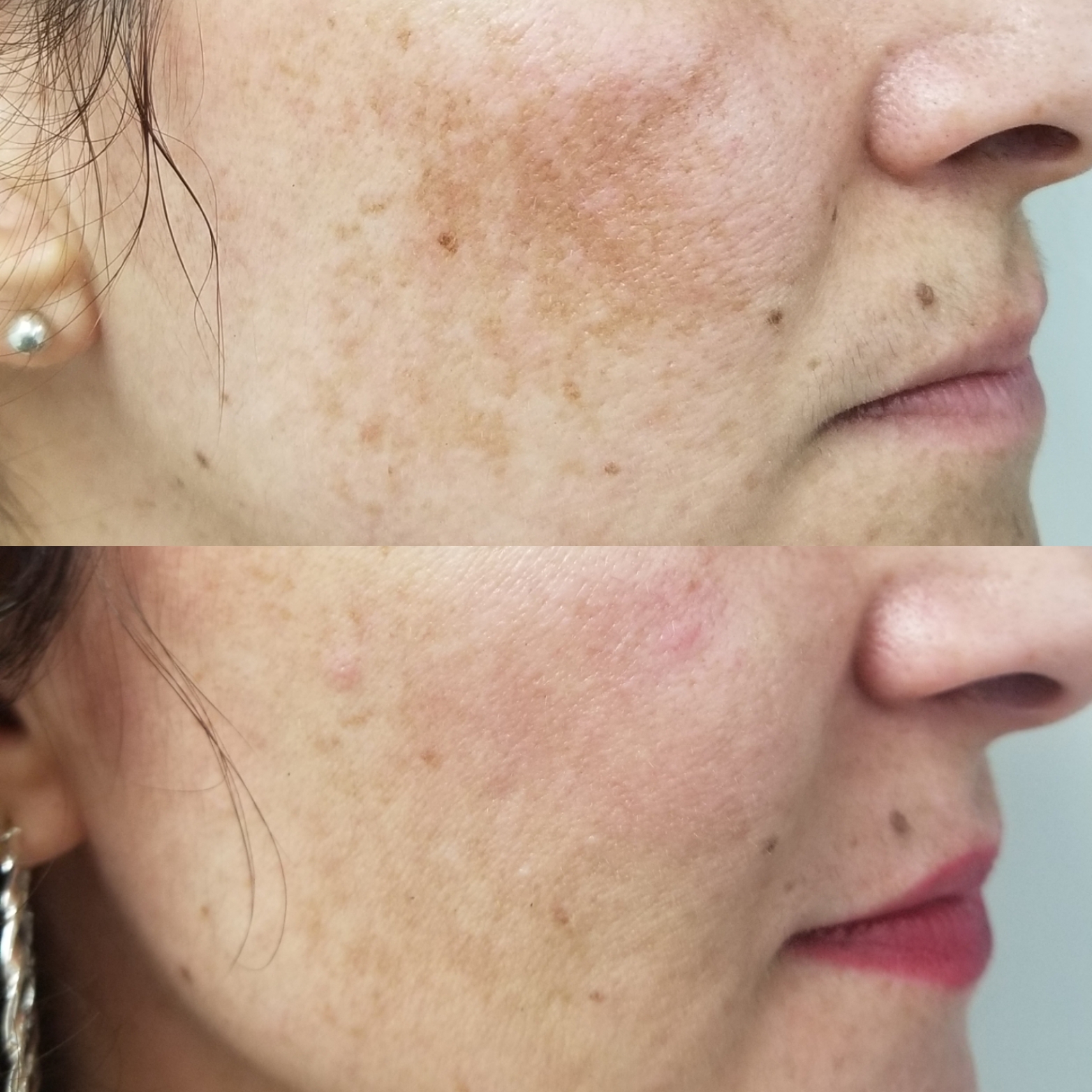 Melasma 3 Antes y Despues