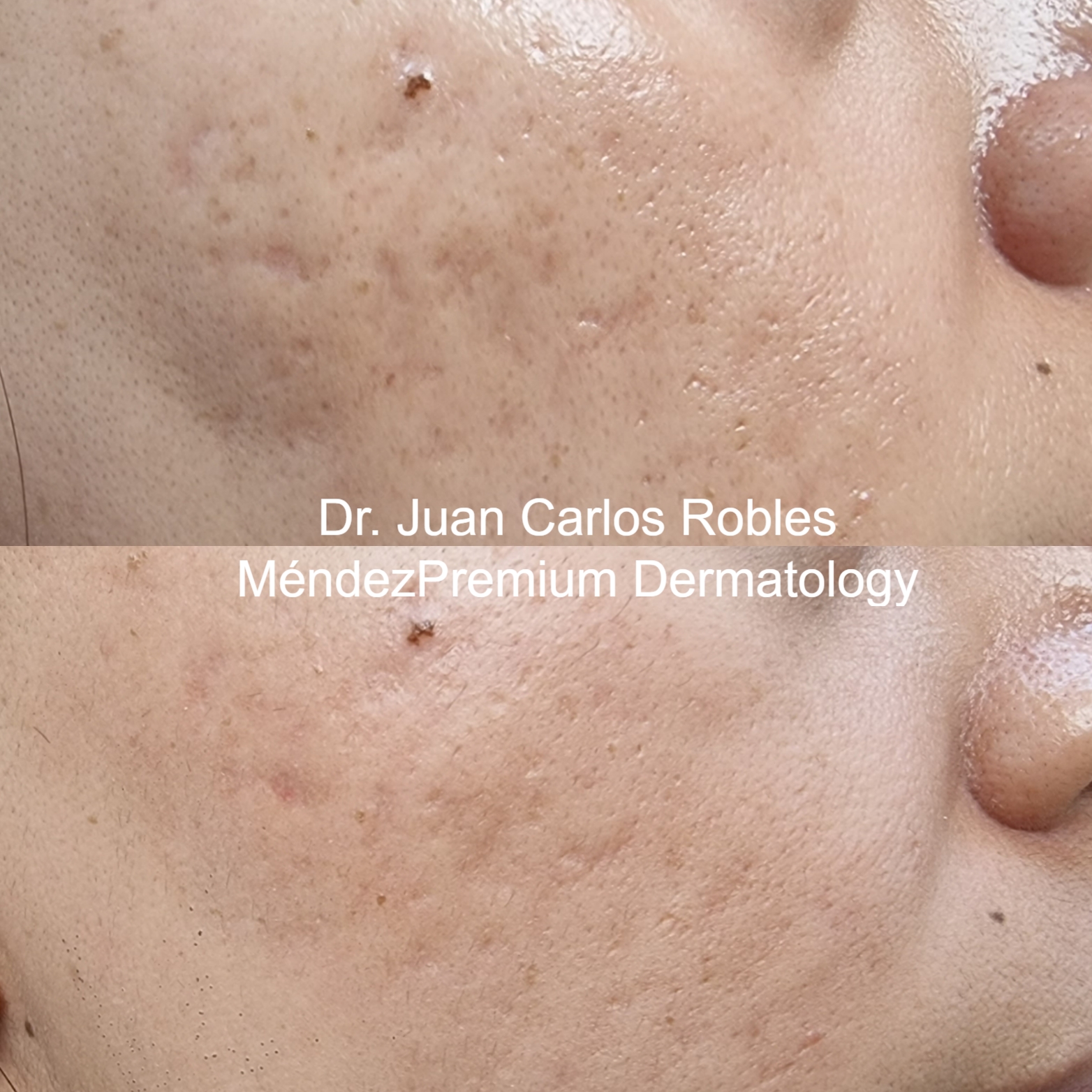 Laser-CO2-3-Antes-y-Despues