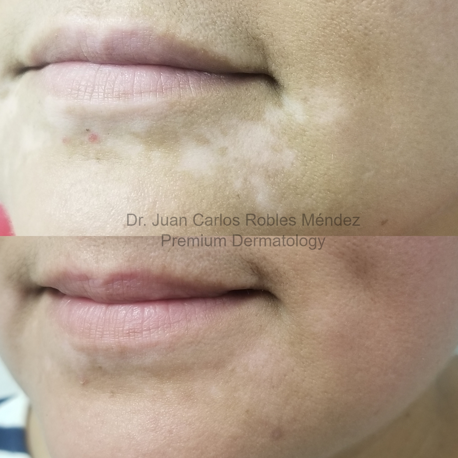 Vitiligo-2-Antes-y-DespuesA