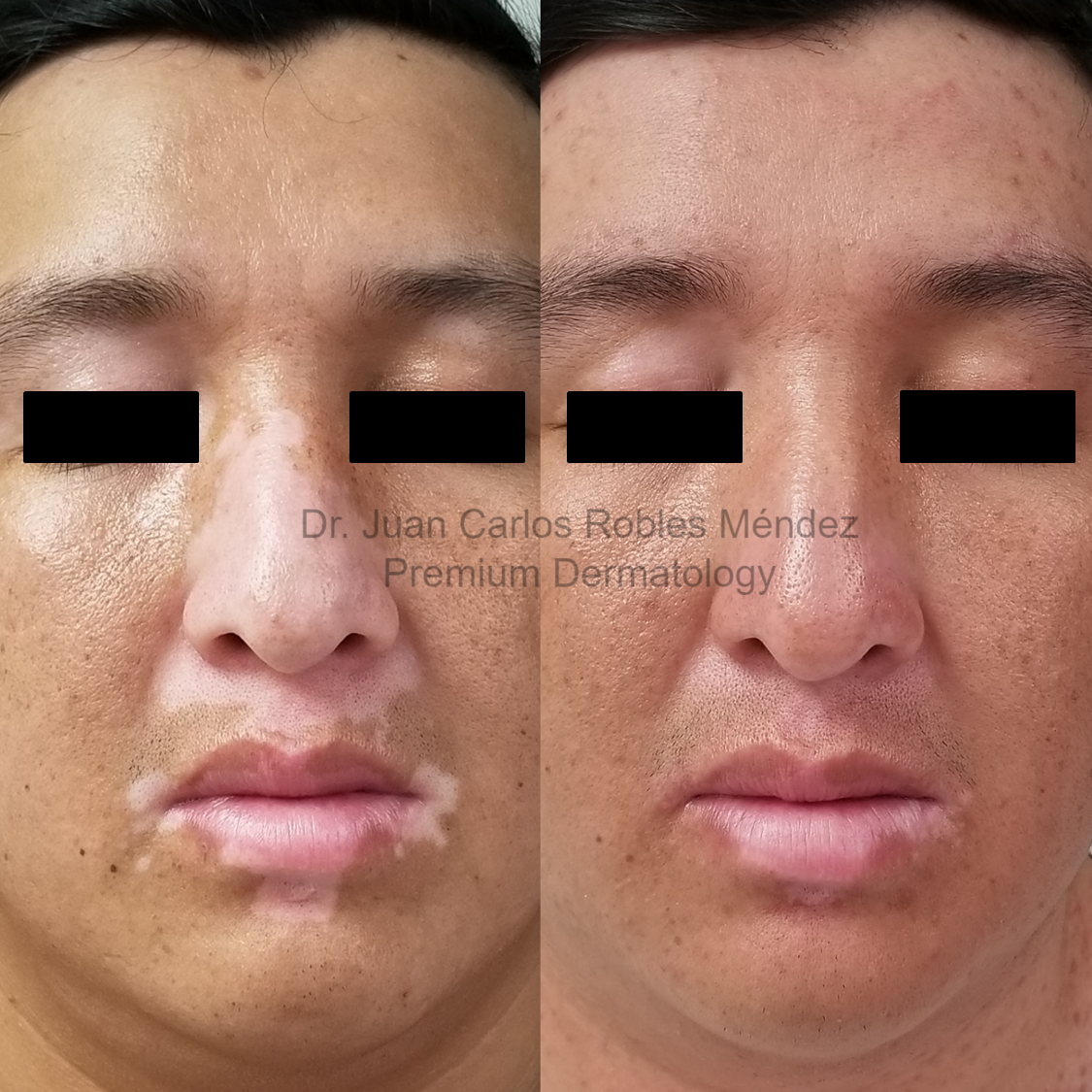 Vitiligo-3-Antes-y-DespuesA