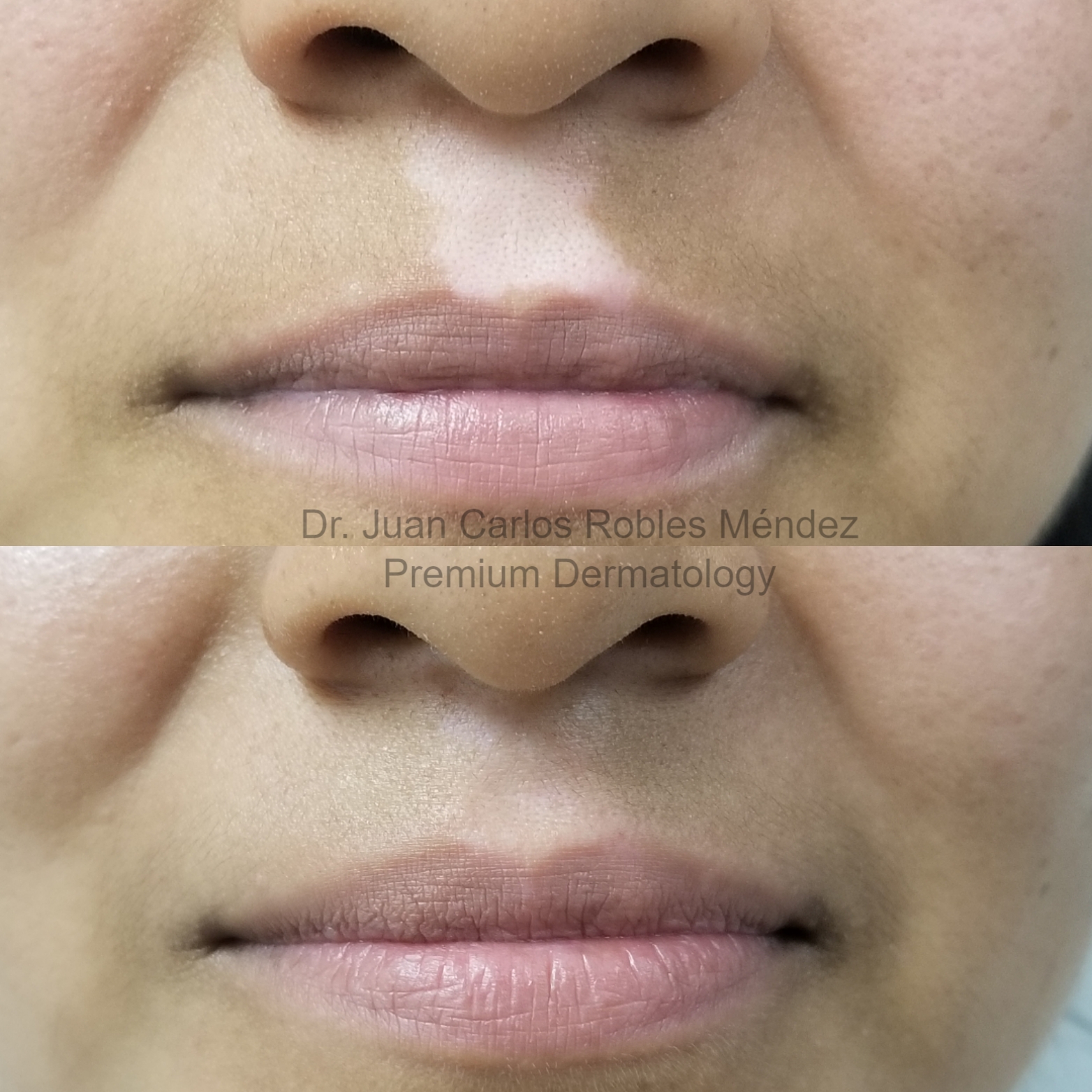 Vitiligo-4-Antes-y-DespuesA